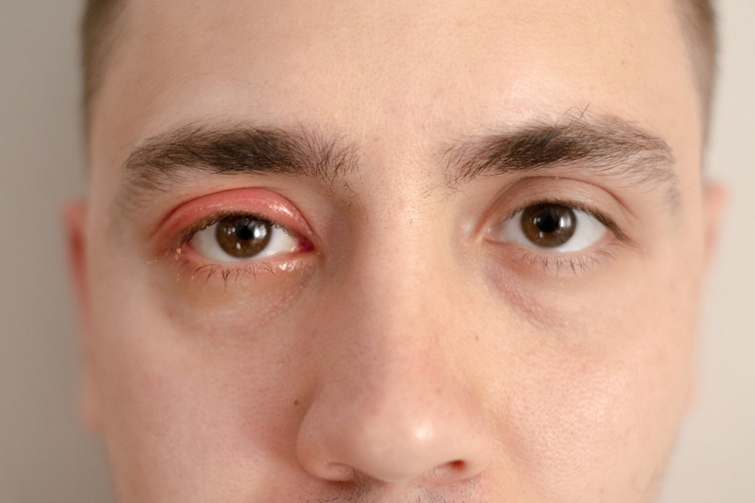 Understanding Eyelid Styes: Causes, Treatment, and Prevention – See ...